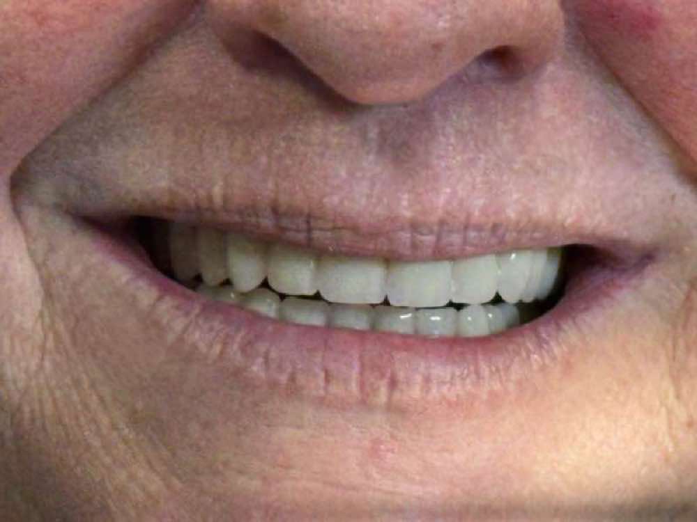 المريض يبتسم بثقة مع أطقم أسنان كاملة ذات مظهر طبيعي