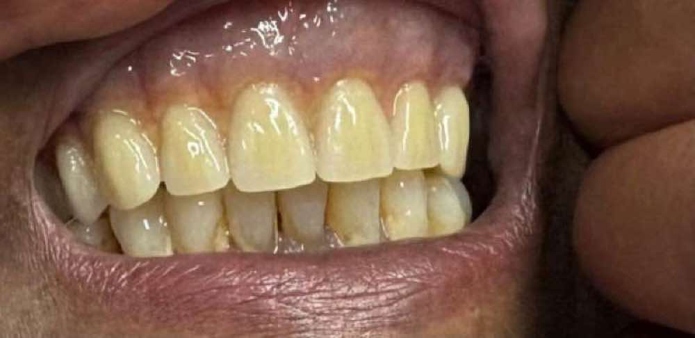 المريض قبل تلقي أطقم الأسنان المخصصة المتميزة
